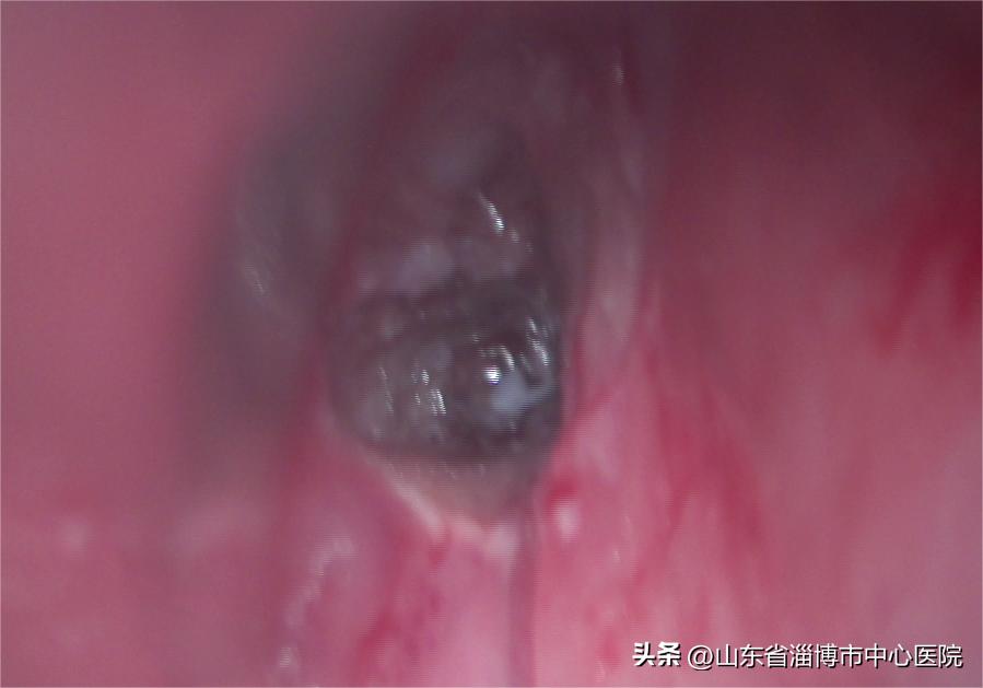 咽喉微创手术县级医院能否做,咽喉部的微创手术