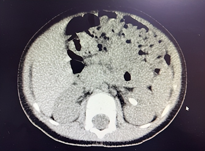 北京大学人民医院保胆取石,儿童结石微创手术