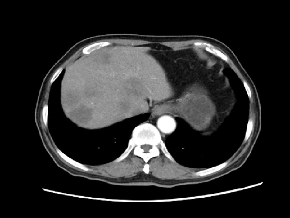 her2阳性乳腺癌2期治愈率,her2阳性乳腺癌新辅助治疗方案