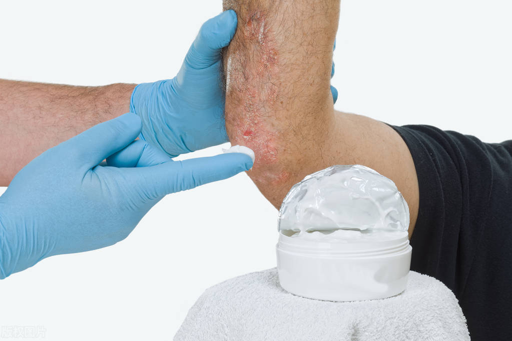 银屑病医案,银屑病中医辨证及方药论文