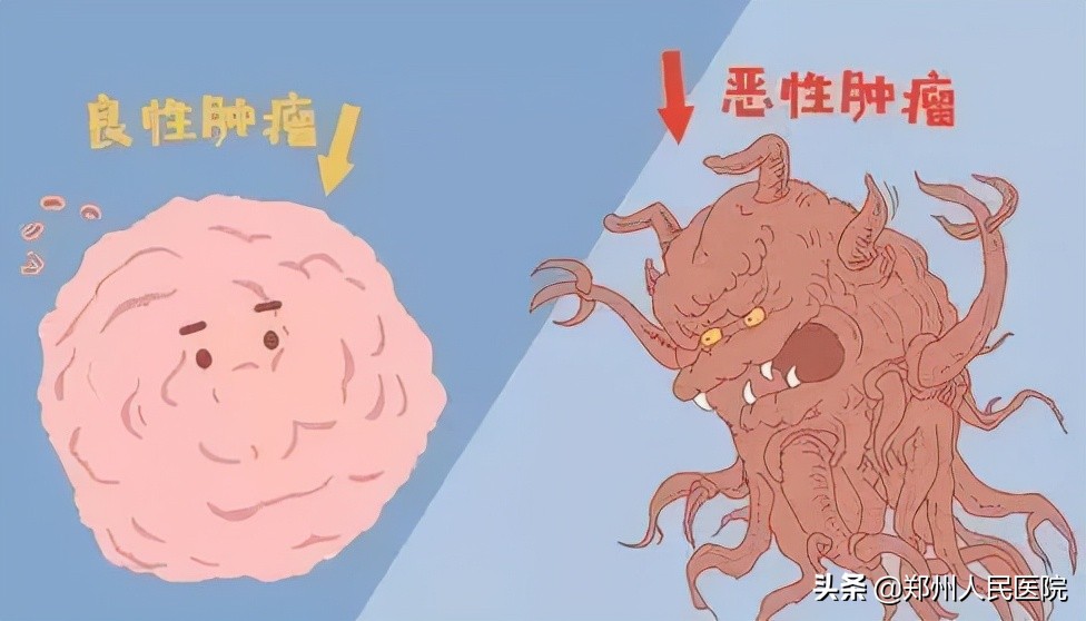 如何预防囊性肿瘤及囊肿,囊肿和肿瘤的判断方法