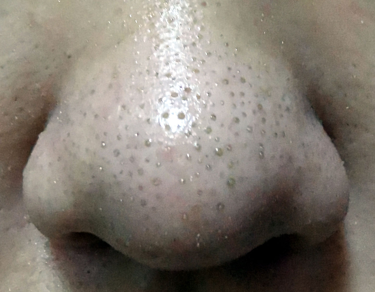 真黑头假黑头傻傻分不清楚，怎么去黑头？