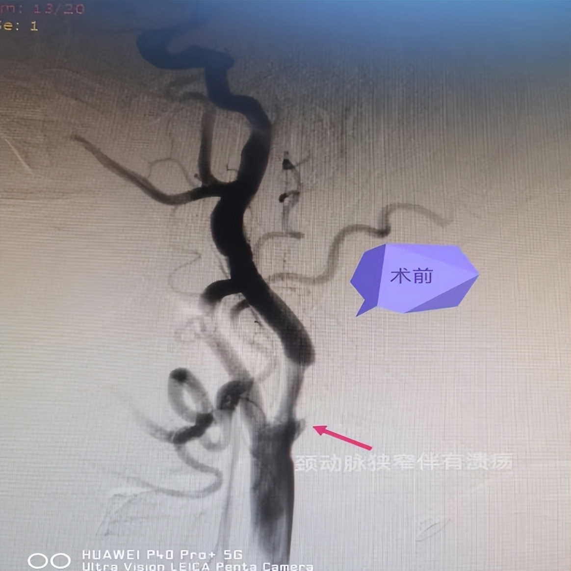 沣东院区脑病病区成功完成多例脑血管造影及颅内支架植入术