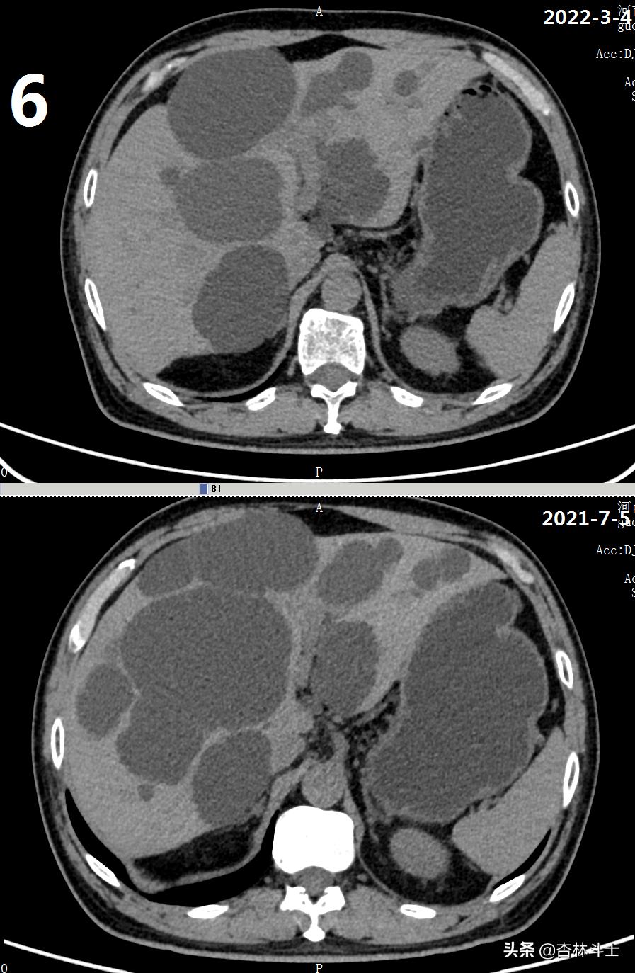 64岁银行职员患肝囊肿，CT引导下细针穿刺抽吸酒精硬化解决大问题