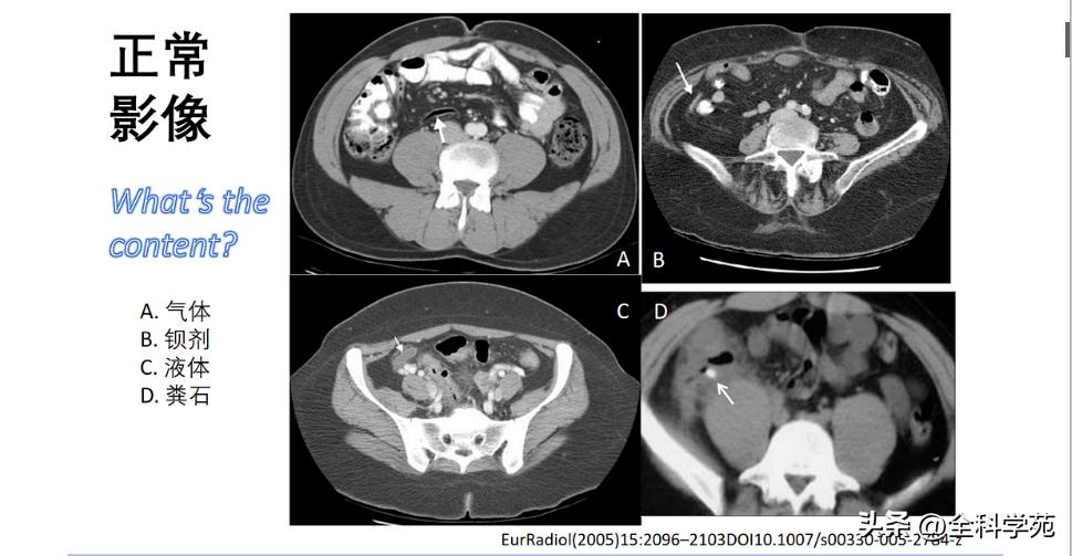 阑尾炎的讲解,关于阑尾炎的讨论总结