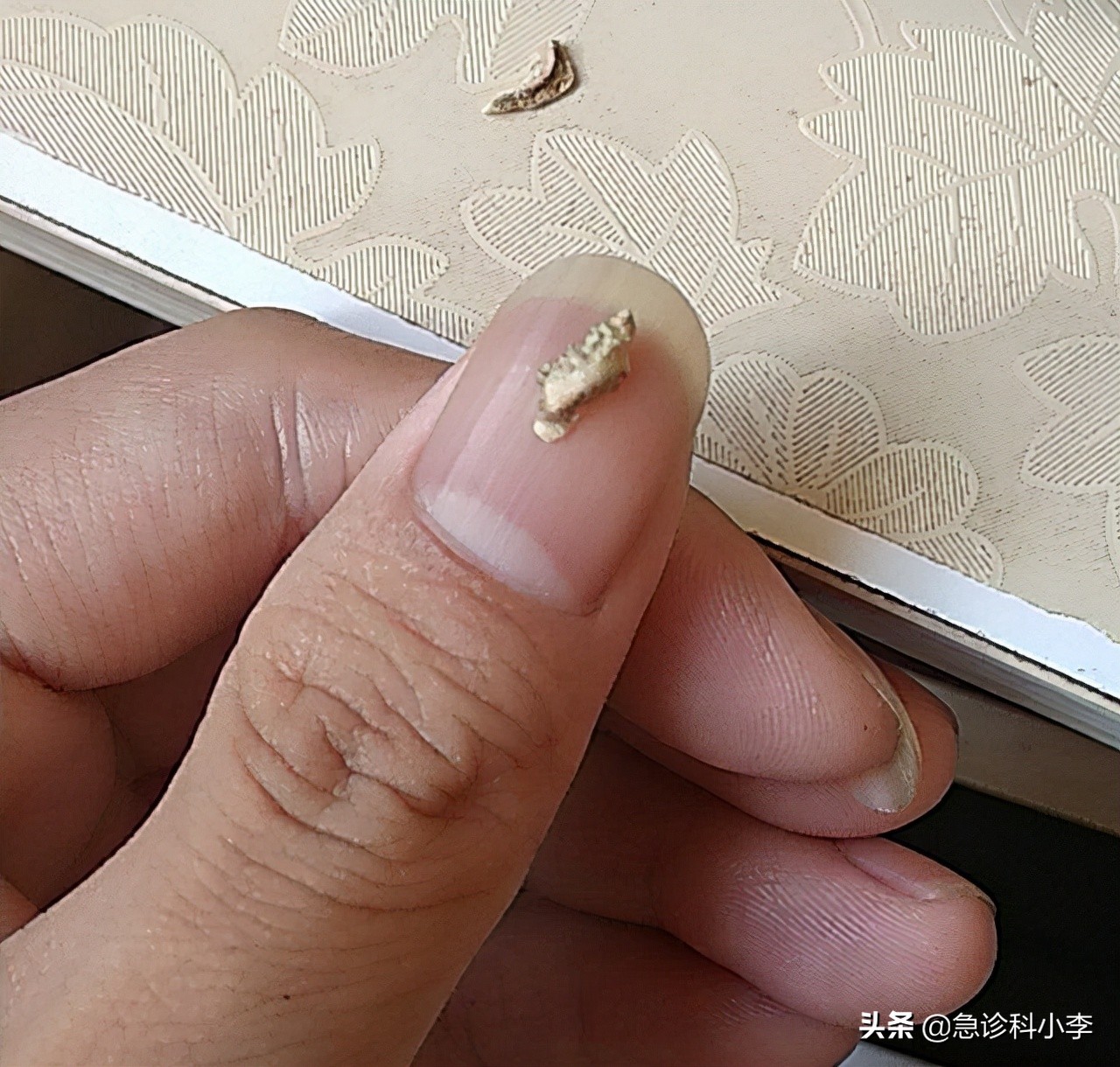 牙缝里的牙结石如何清除干净,在牙缝里的牙结石要怎么去除