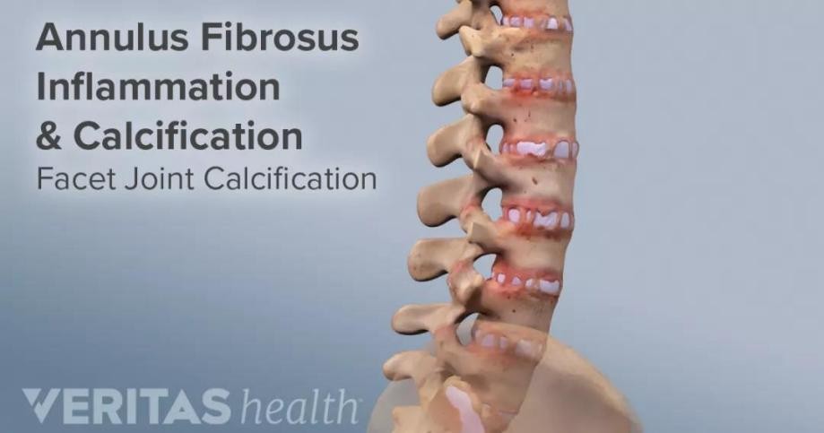 治疗强直性脊柱炎必须按体质治吗,针对强直性脊柱炎最好的锻炼方法