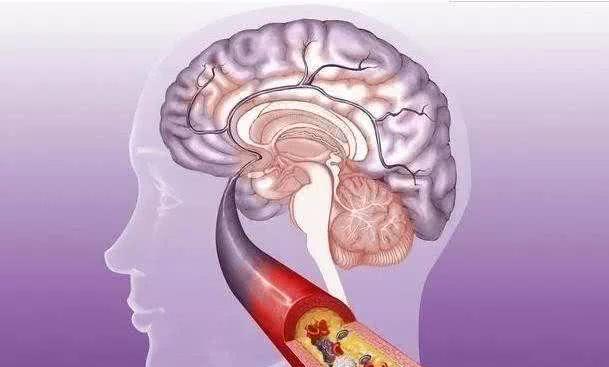 为什么脑梗病人吃得很少,为什么脑梗病人吃的特别多