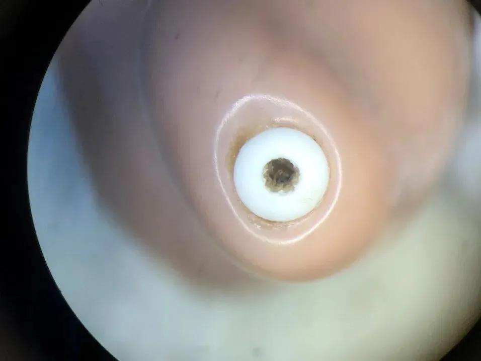 麦克风有异物堵住孔了怎么处理,手机麦克风孔被异物堵了怎么办