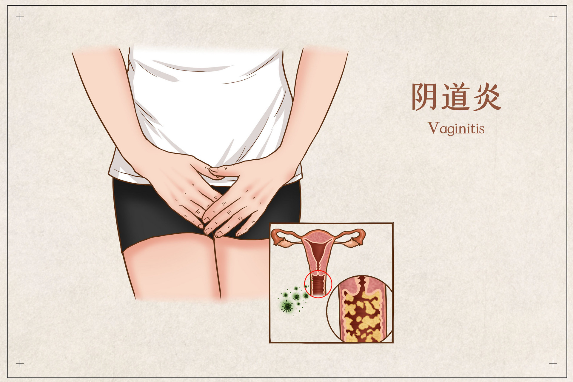 如何预防老年性阴道炎症状,如何预防老年性阴道炎的症状