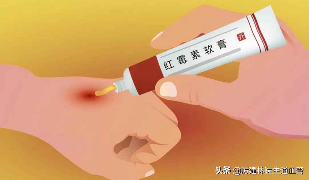 红霉素软膏和红霉素眼膏有何区别,红霉素软膏和红霉素眼膏具体区别