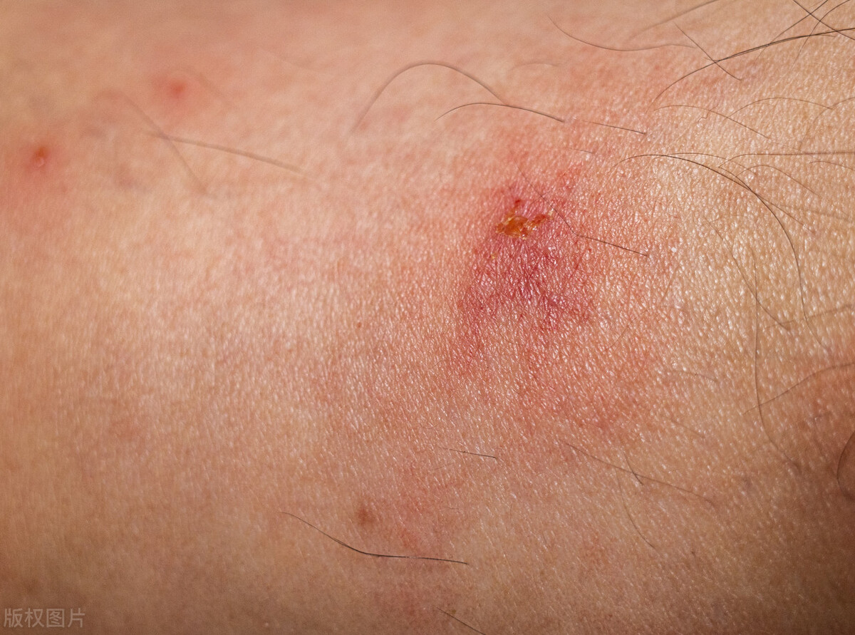 医生:脖子腋下长出“小肉粒”,警惕HPV病毒!抠掉当心感染危害