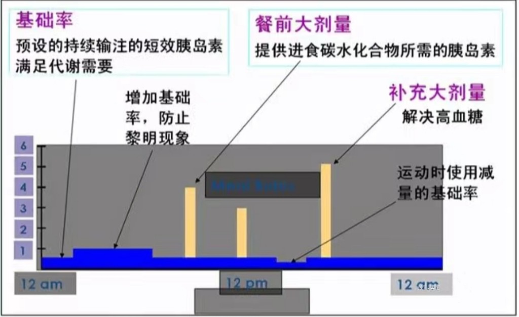 胰岛素泵的基本知识,经验之谈肺腑之言精典