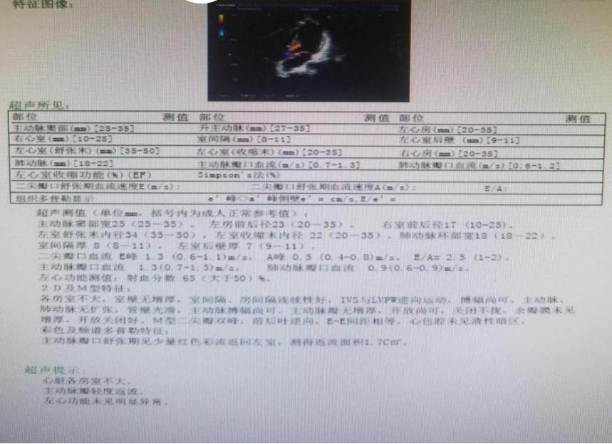 心肌炎误诊心肌梗塞,心肌炎可能误诊吗