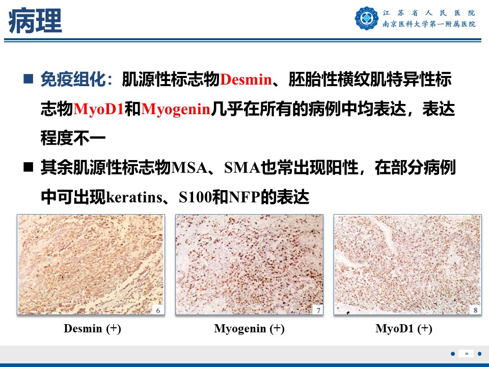好文分享——《胚胎型横纹肌肉瘤》