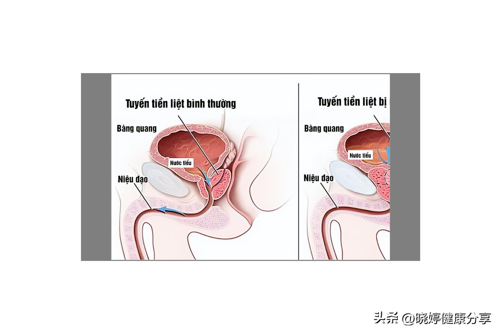 前列腺癌影响男性生育能力吗,前列腺癌会影响心脏吗