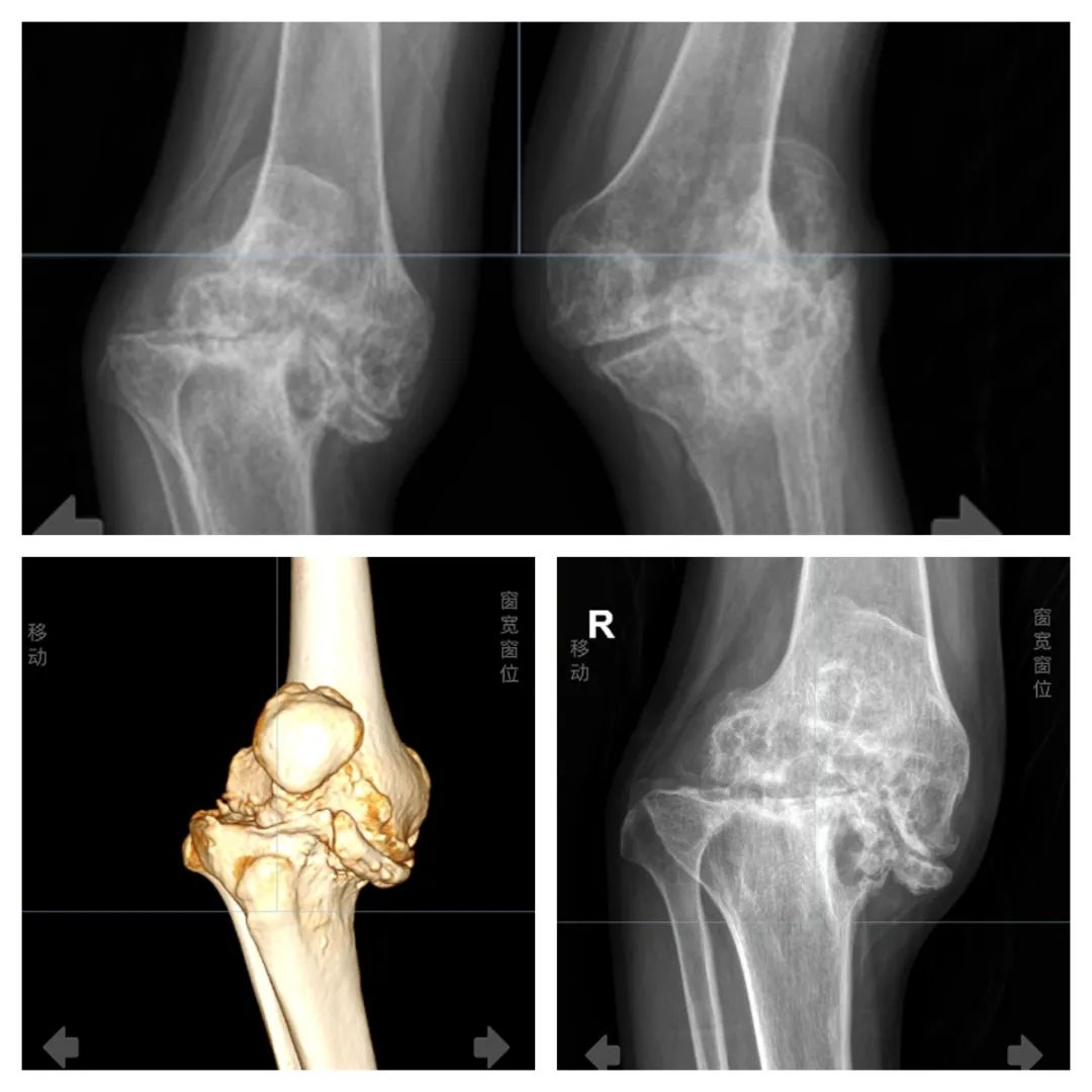 血友病患者的福音,禾正骨科助您完成轮椅上的“逆袭”!
