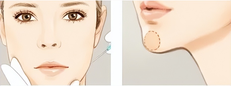 九院韦敏下颌角截骨案,上海九院韦敏下巴假体做的怎样