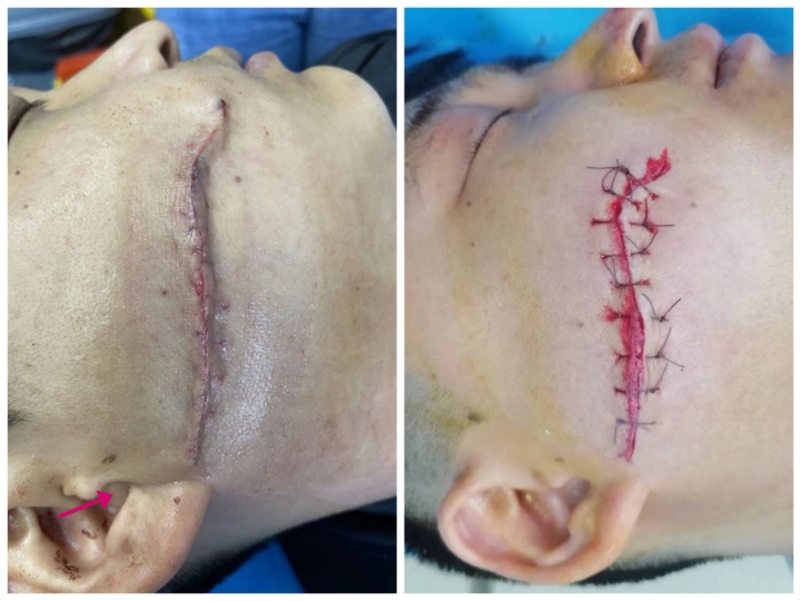 疤痕早期激光干预,疤痕激光治疗最佳方法