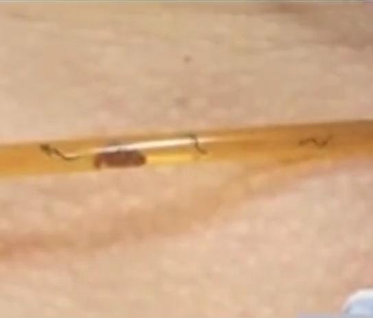 故事：湖北55岁男子病从口入，孕出成千上万虫卵，肚子竟成虫窝