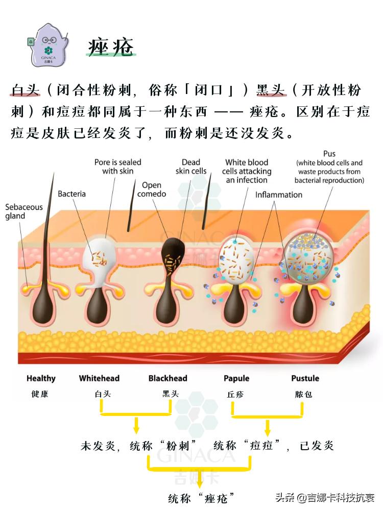如何祛痘的方法最有效,怎样祛痘最快最有效10个小方法