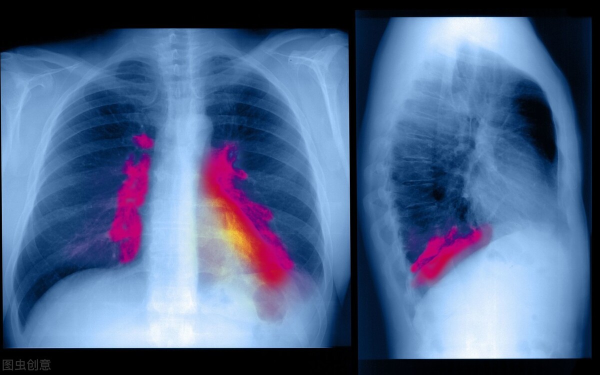 肺部寄生虫感染的症状,肺部有感染要怎么治
