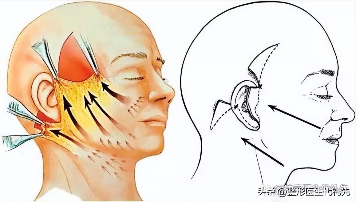 耳后额头拉皮是大拉皮还是小拉皮,拉皮手术在哪个季节做最合适