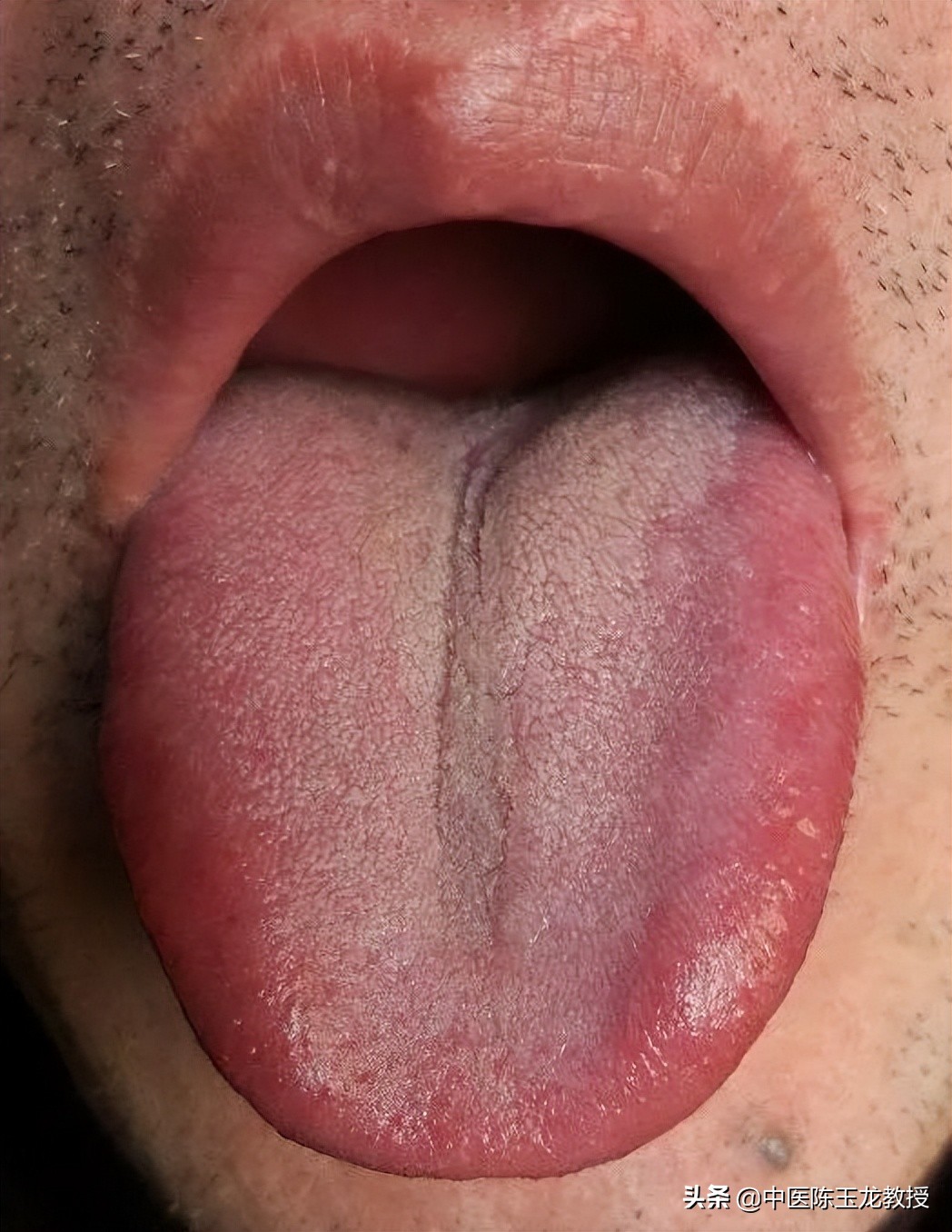 湿热最怕的草药,脾胃湿热和肝胆湿热同治的中成药