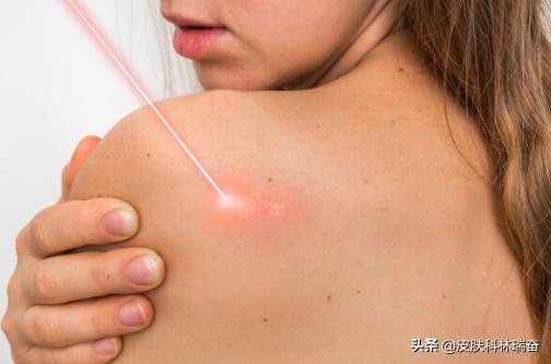 脸上祛痣留下了很深的凹陷疤痕,点痣后脸上凹下去疤痕怎么去除