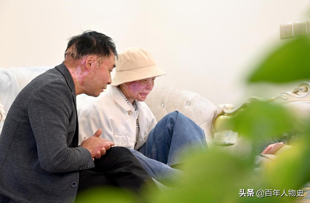 19年,四川20岁女孩遭大火毁容48%烧伤,双臂截肢如今怎么样了?