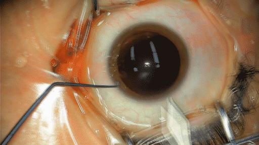 icl植入术技术问题,icd植入适应症指南