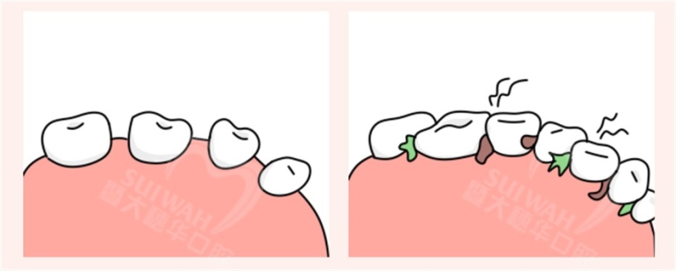 牙齿缝隙越来越大是怎么回事,45岁牙齿缝隙越来越大能矫正吗