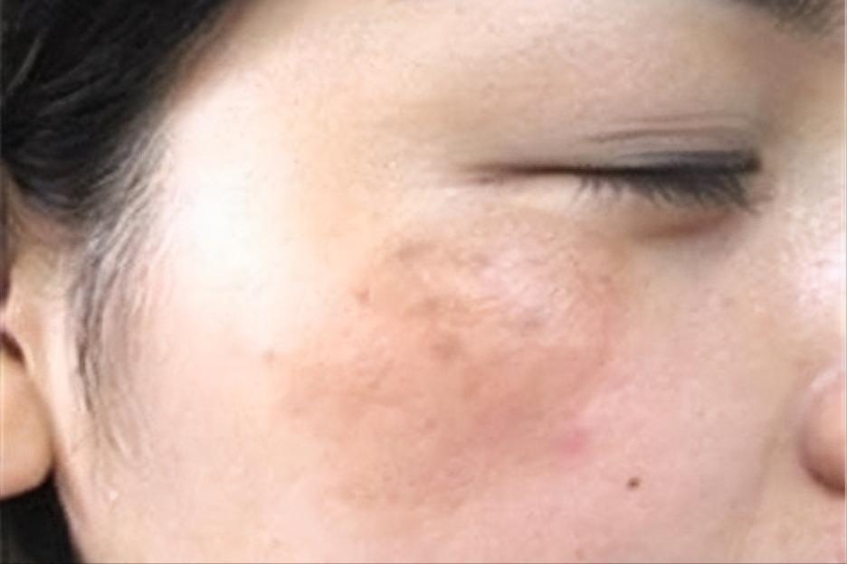 肝郁症状面部有黑斑,肝郁气滞黧黑斑