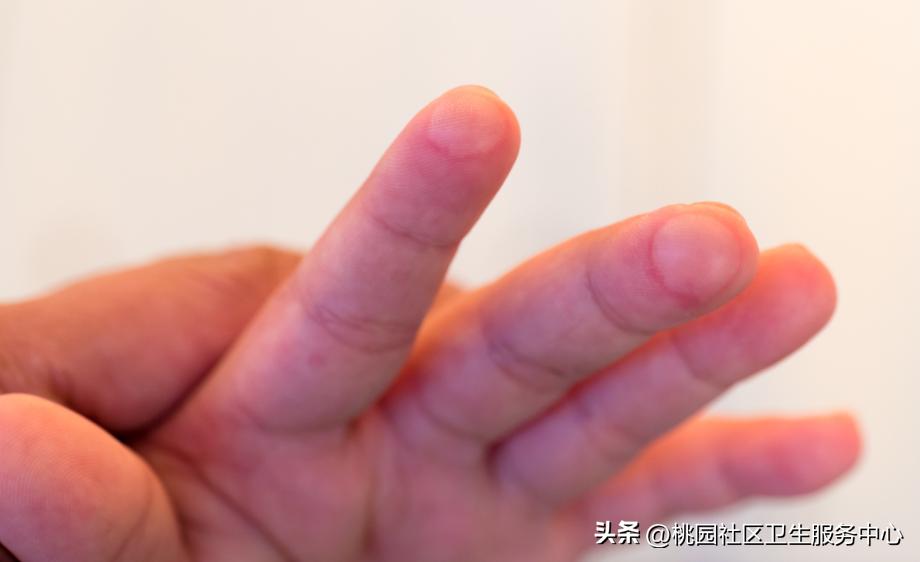 烫伤后抹牙膏怎么洗掉,烫伤涂牙膏酱油有什么作用