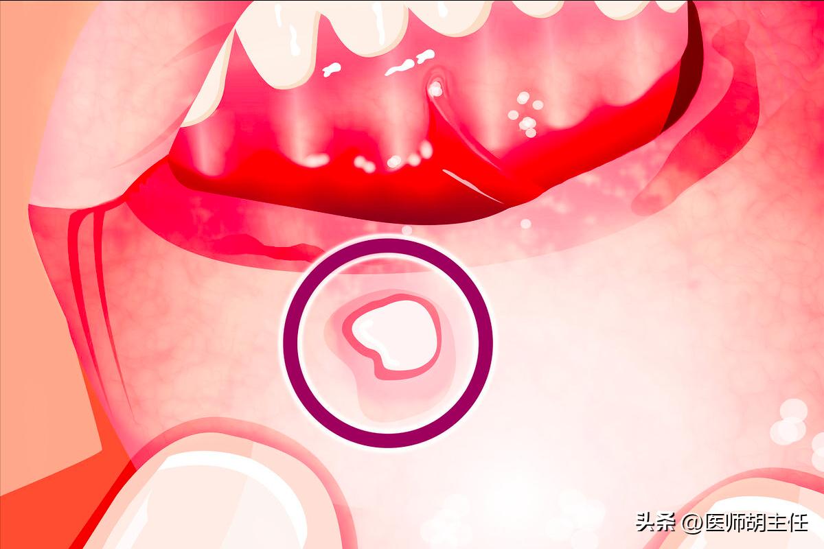 口腔溃疡吃维生素b1b2b12维生素c,治疗口腔溃疡的是维生素b2还是b12