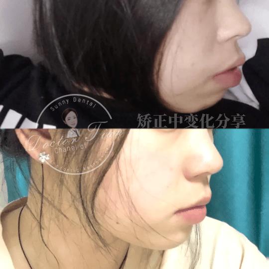 凸嘴下巴后缩拔牙改善有什么坏处,深覆合嘴凸下巴后缩矫正要拔牙吗