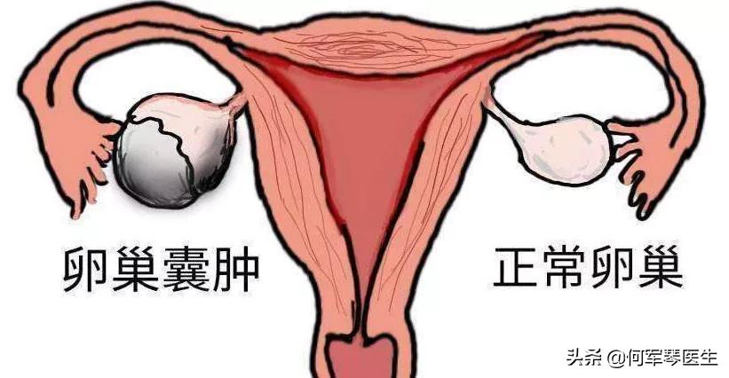不要被肿瘤吓到,卵巢囊肿是怎么回事