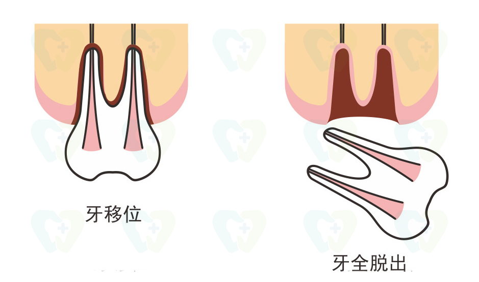 牙齿磕掉怎么判断伤到牙神经,牙齿不小心磕松怎么能恢复