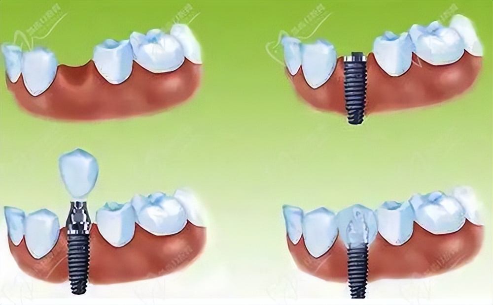 襄阳口腔牙齿种植价格,襄阳种植牙价格是多少钱