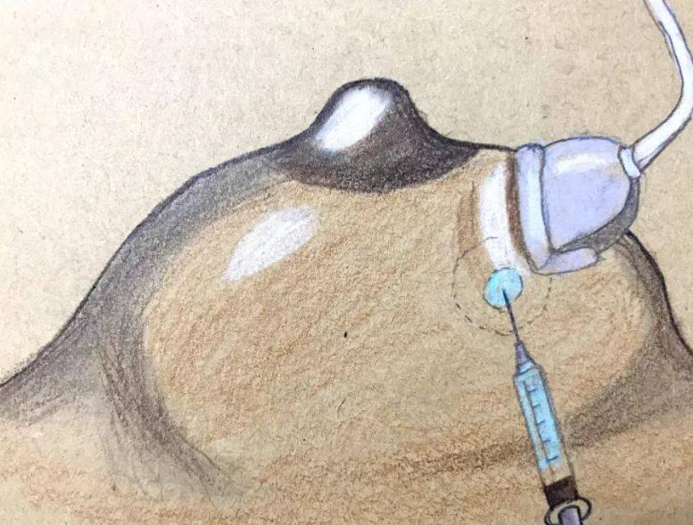 乳晕长了小疙瘩,正常吗?难不成是乳腺癌