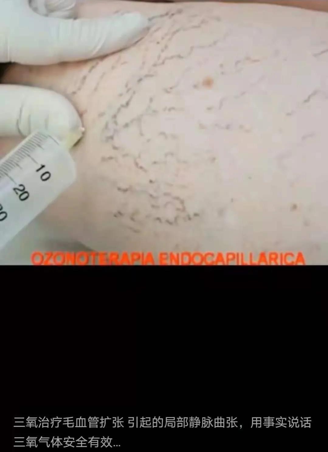 臭氧治疗静脉曲张好不好,臭氧疗法治疗静脉曲张效果怎么样