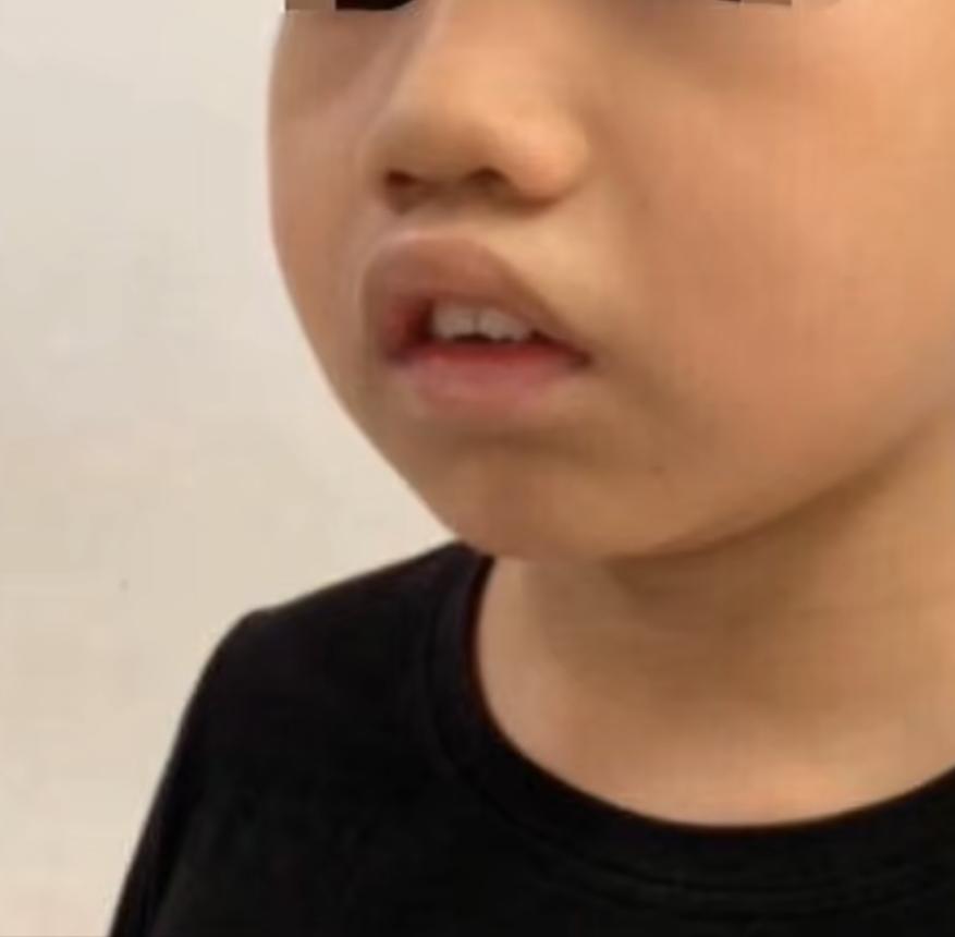 河南儿科专家黄甡腺样体肥大,儿童腺样体肥大的危害你了解多少