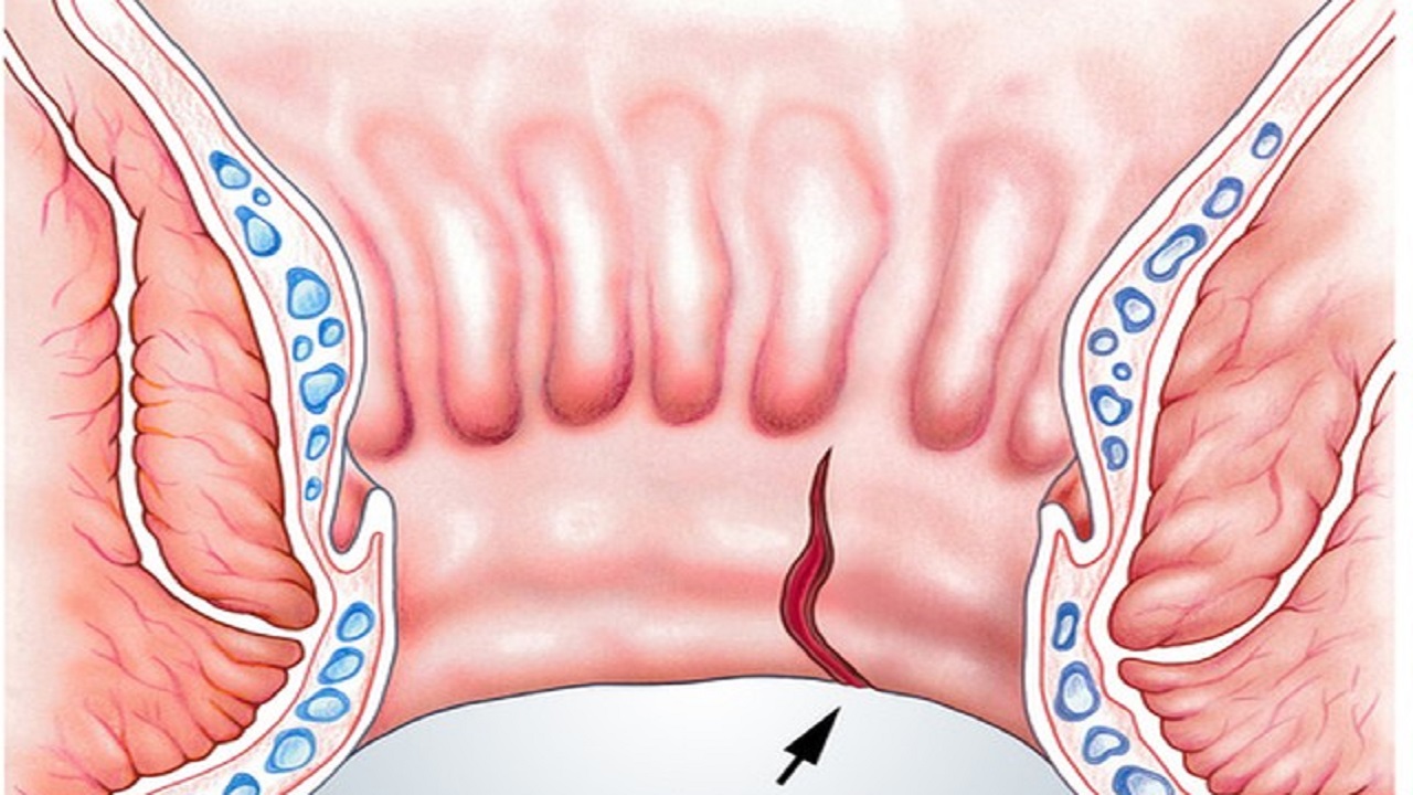 24岁女生肛裂正常吗,16岁女孩经常肛裂怎么治疗