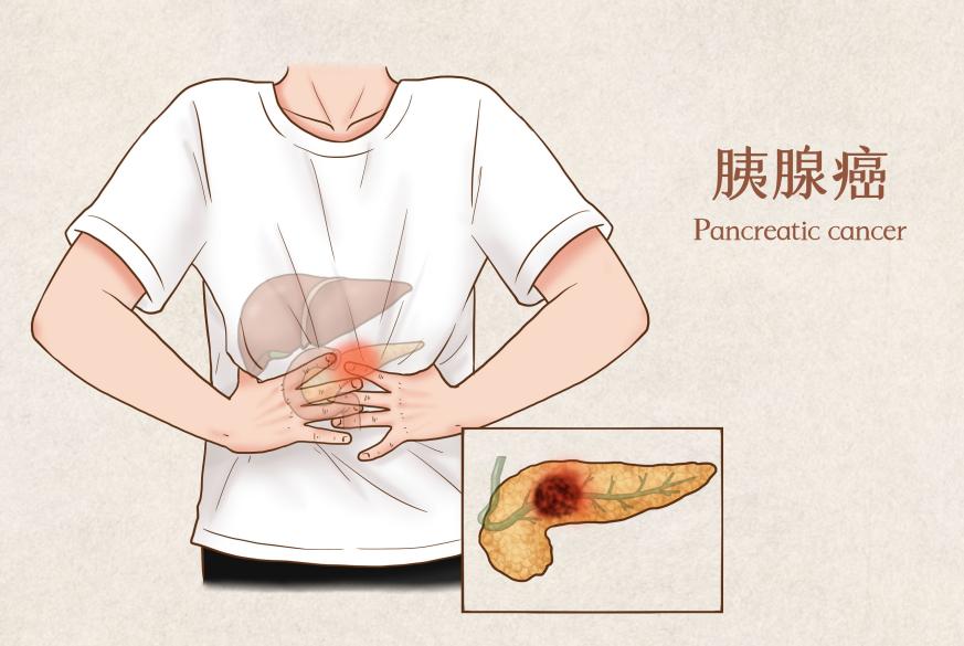 胰腺癌如何介入治疗,胰腺癌手术治疗预后怎样