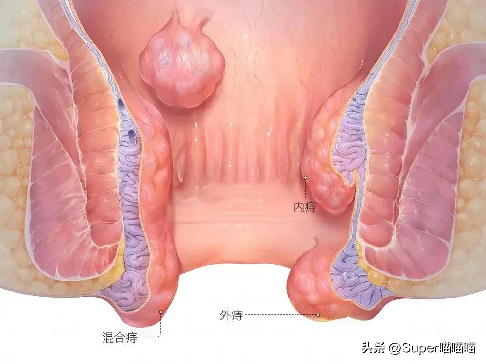 痔疮手术第三天怎么越来越痛了,吻合器痔疮手术和传统痔疮手术