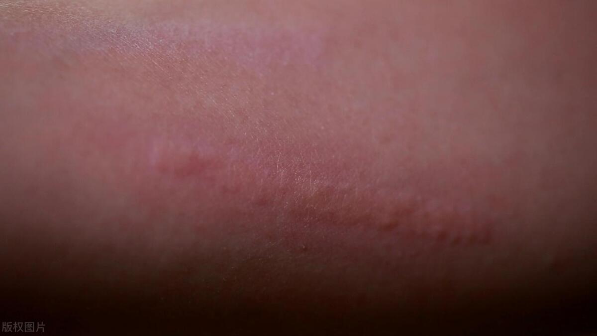 焗油过敏引起过敏性皮炎怎么办,过敏性皮炎螨虫过敏怎么治合适