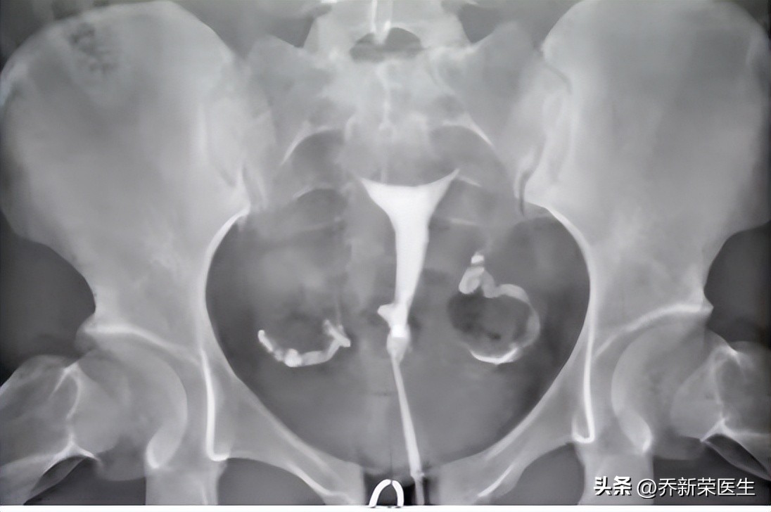 输卵管造影能疏通输卵管吗,输卵管造影可以疏通输卵管吗