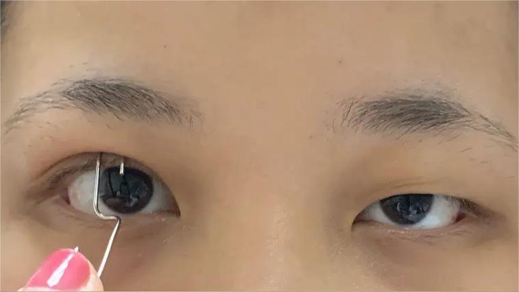 双眼皮手术后眼睛淤紫怎么消除,双眼皮术后眼头紧绷有细纹