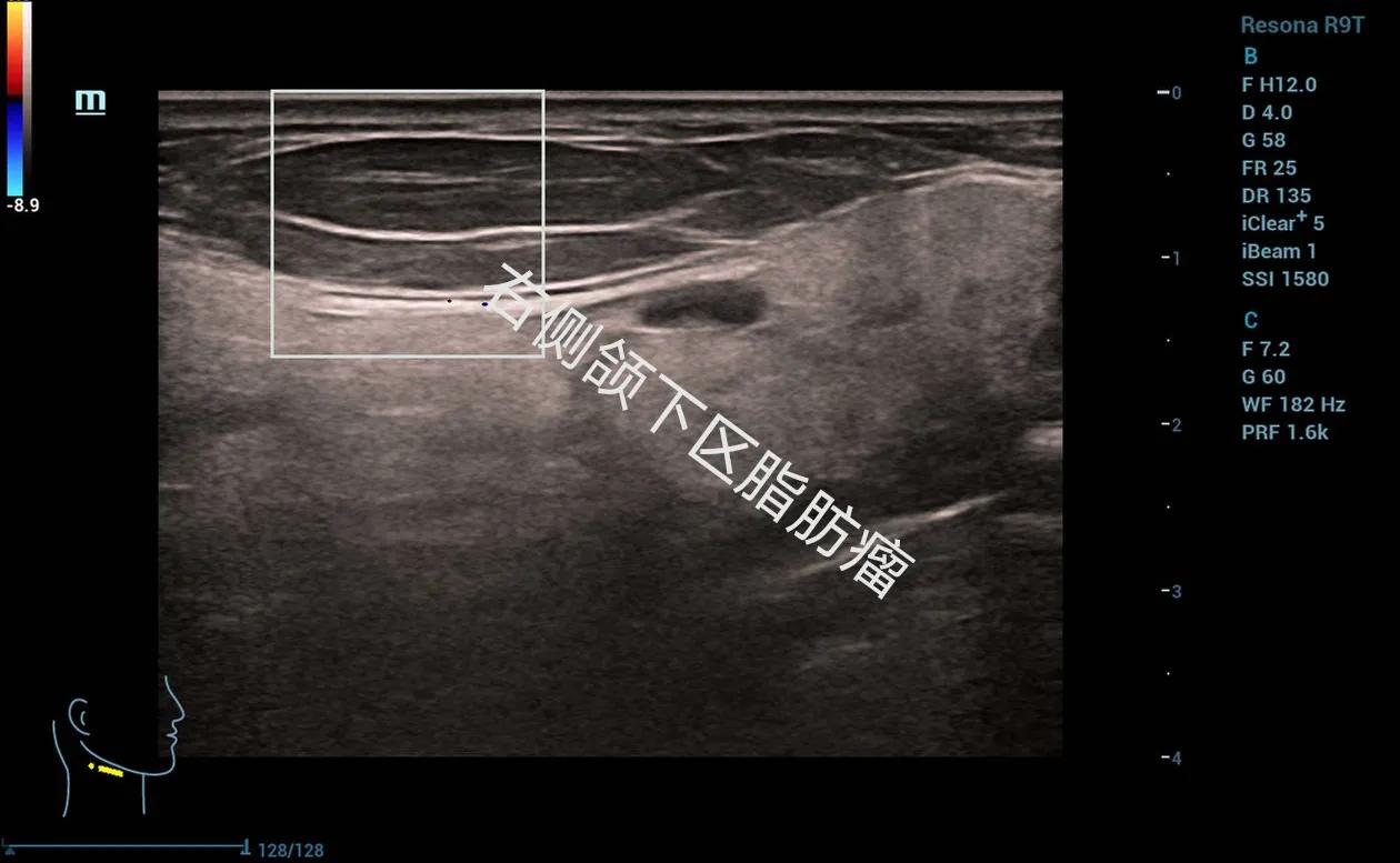 身体腰背部腹部两侧有小硬疙瘩,大腿和腰部起了大片的疙瘩