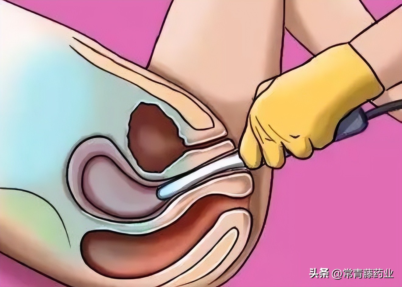 B超中有一种叫“阴式B超”的检查？会感染、疼痛？别多虑了